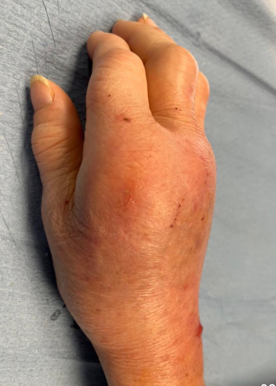image morsure